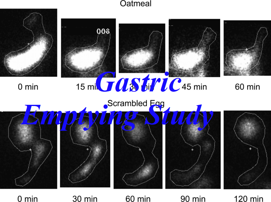 What is Gastric Emptying Study? Example