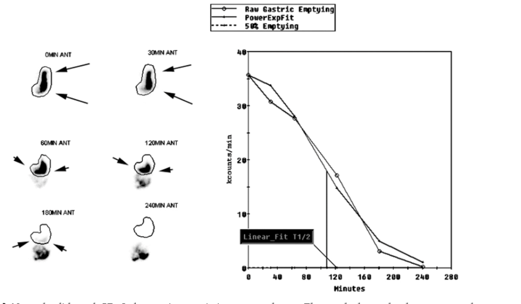 What Is Gastric Emptying Study? Example – Health Maintain