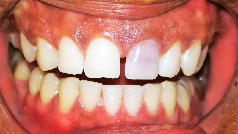 Why Are My Teeth Yellow? Top 6 Causes of Discolored Teeth