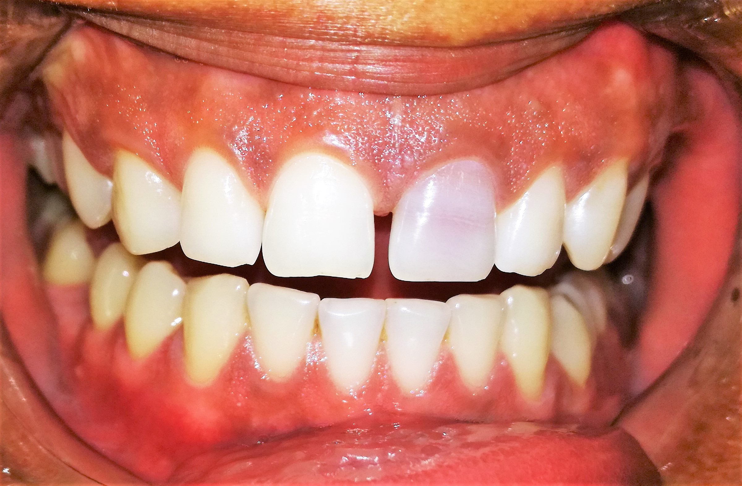 Why Are My Teeth Yellow? Top 6 Causes of Discolored Teeth