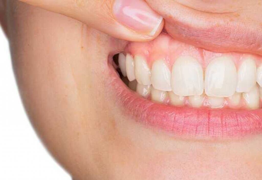 What’s In Your Smile? Knowing The Signs of Gingivitis
