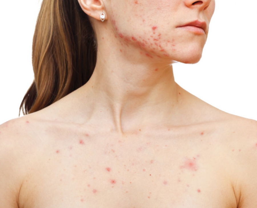 How to Get Rid of Body Acne: 5 Great Strategies