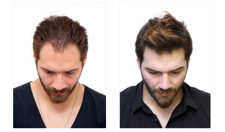 Pune is One of the Best Places in India for Hair Transplant. Here’s why!