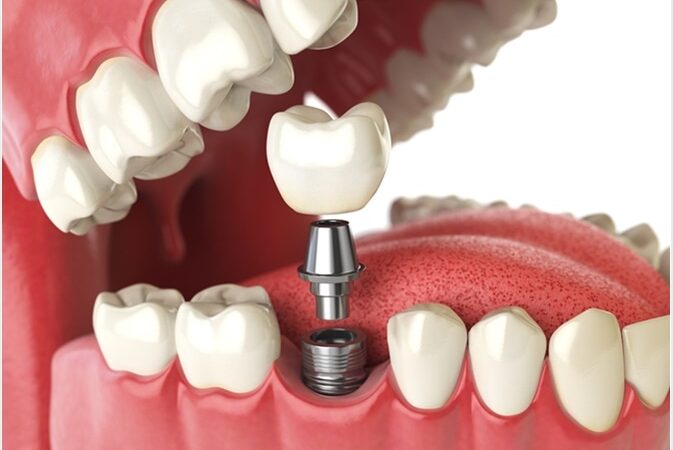 A Basic Guide on the Different Types of Dental Implants