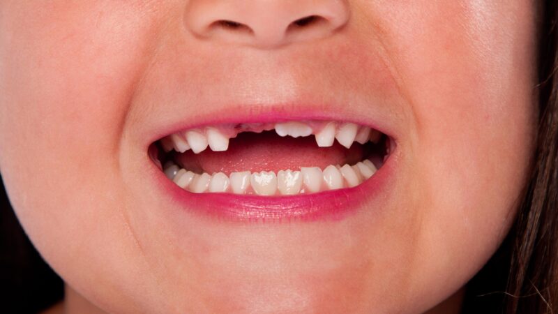When Do Children Lose Their Baby Teeth: A Definitive Guide