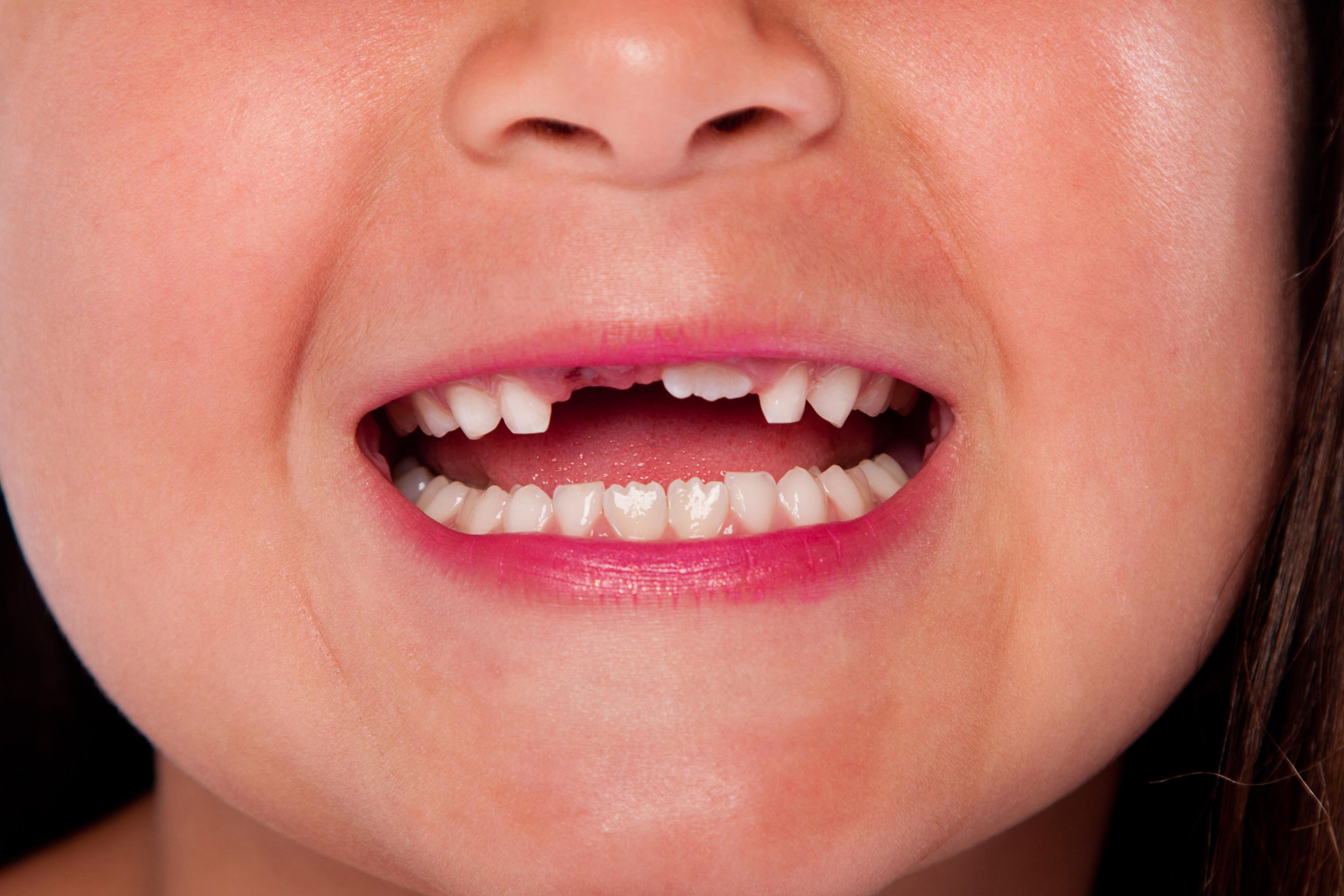 When Do Children Lose Their Baby Teeth: A Definitive Guide