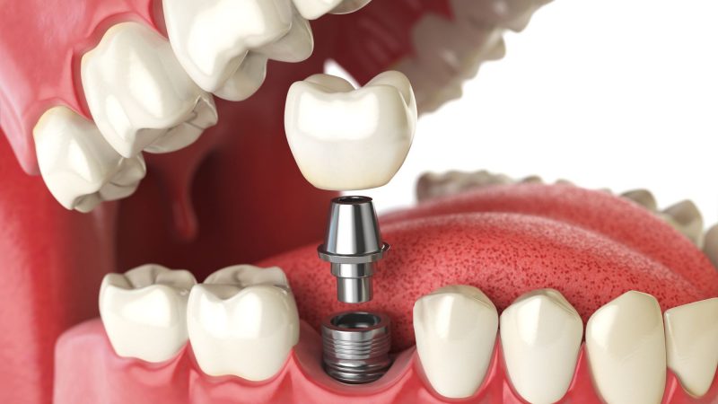 Preparation and Aftercare Tips for Tooth Implants