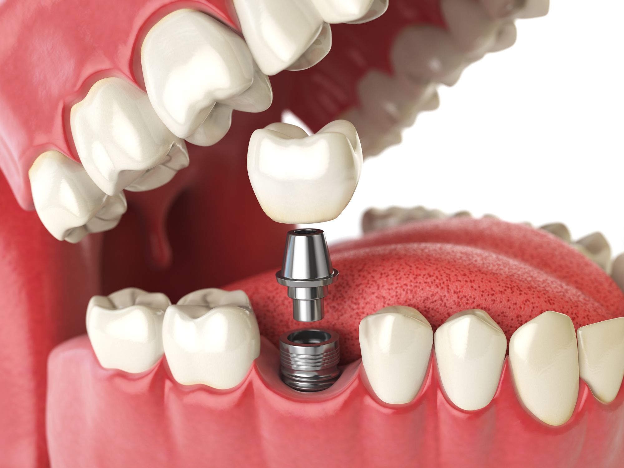 Preparation and Aftercare Tips for Tooth Implants
