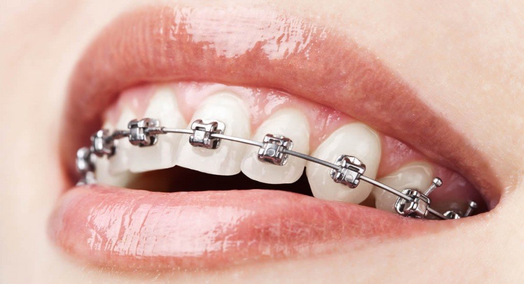 How Much Are Clear Braces?