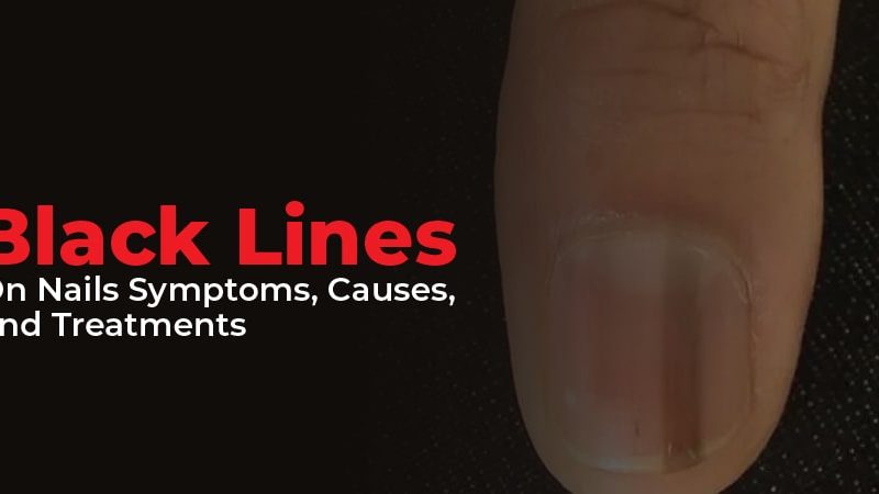 Black Lines On Nails: Symptoms, Causes, and Treatments