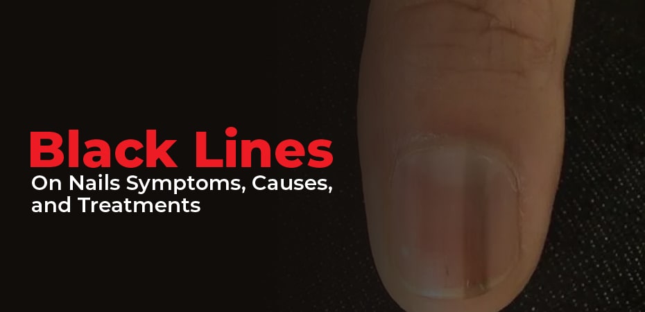 Black Lines On Nails: Symptoms, Causes, and Treatments