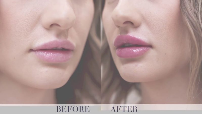 How Can Lip Injections in Vancouver Enhance Your Personality?