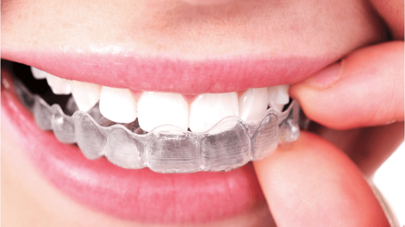 How Much Does Invisalign Cost in San Francisco and What Factors Affect It?