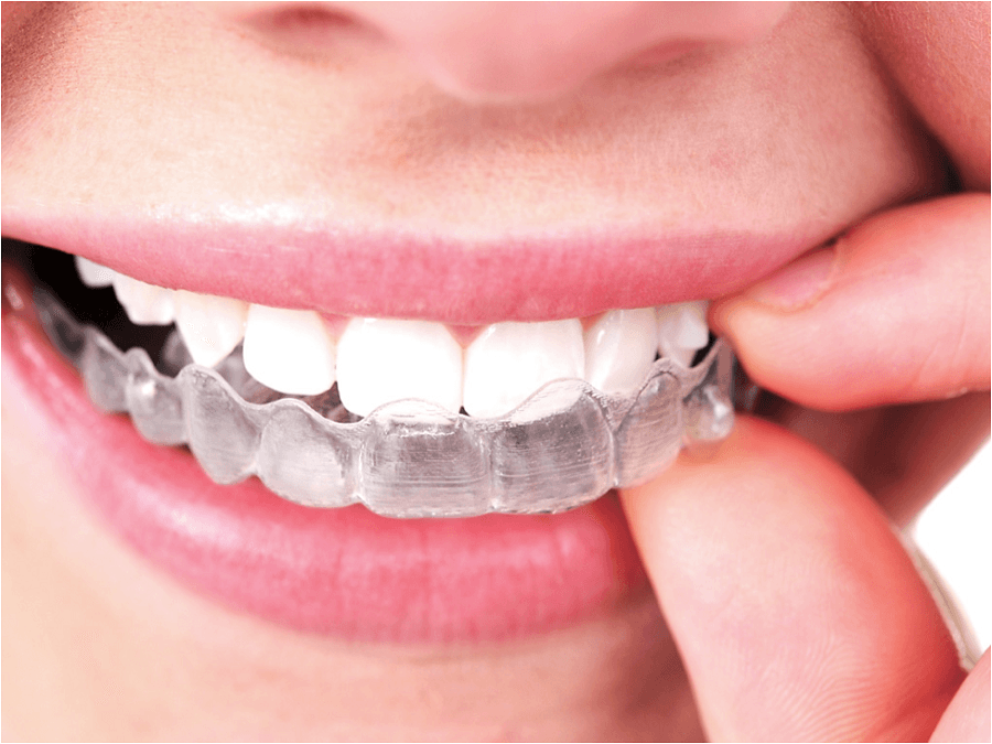 How Much Does Invisalign Cost in San Francisco and What Factors Affect It?