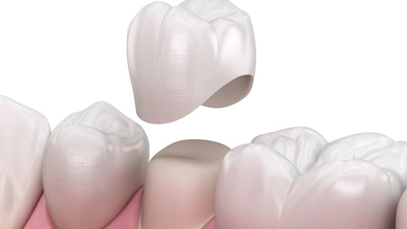 5 Important Facts That You Should Know About Dental Crowns