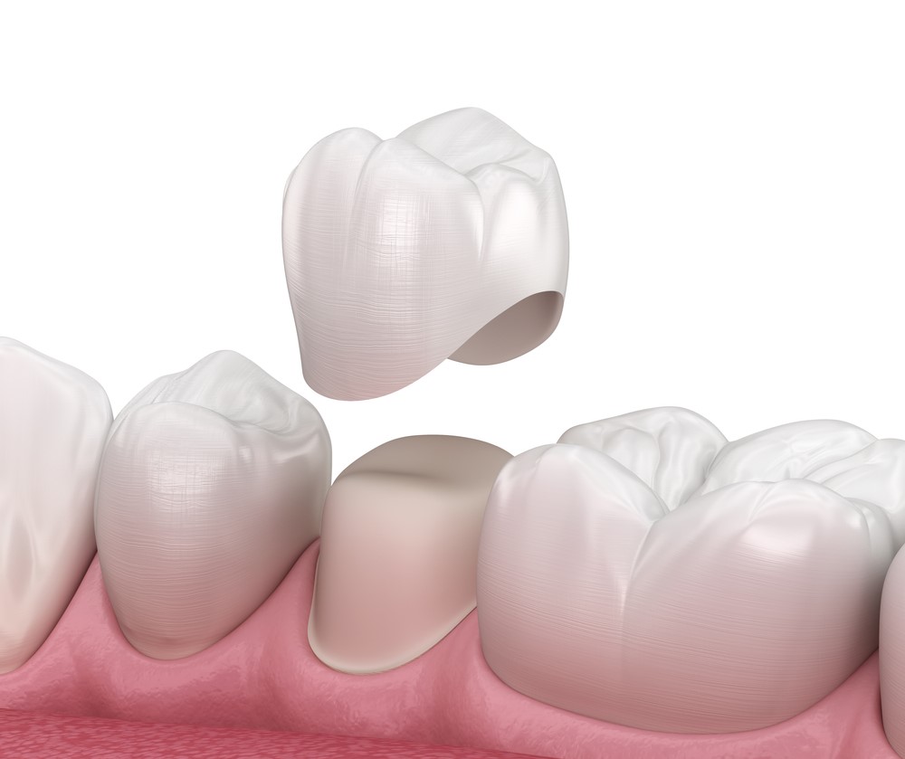 5 Important Facts That You Should Know About Dental Crowns